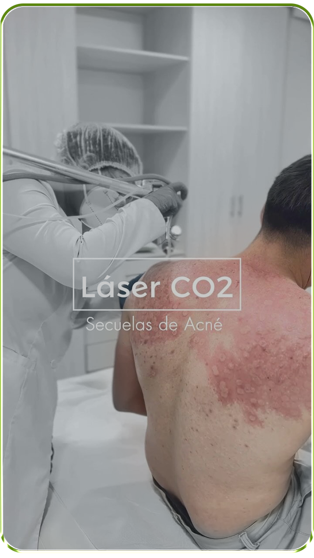 Secuelas de Acné